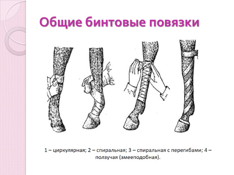 Общие бинтовые повязки 1 – циркулярная; 2 – спиральная; 3 – спиральная с перегибами;